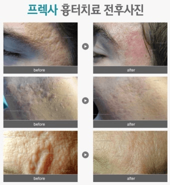 프렉사 레이저 전후 사진